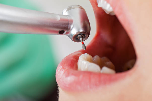 Best Emergency Wisdom Teeth Removal in Chilton, WI
